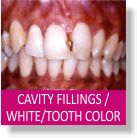 Cavity Fillings