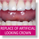 Replacement of Artificial Looking Crown