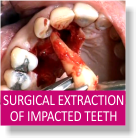 Surgical Extraction of Impacted Teeth