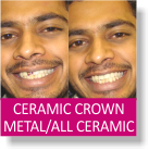Ceramic Crown, All Ceramic / Metal 