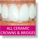 All Ceramic Crowns & Bridges