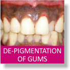 De-Pigmentation of Gums