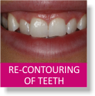 Re-Contouring of Teeth