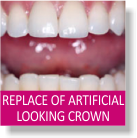 Replacement of Artificial Looking Crown