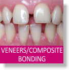 Veneers / Composite Bonding