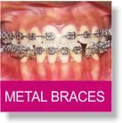 Metal Braces