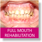 Full Mouth Rehabilitation