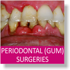 Periodontal Gum Surgeries