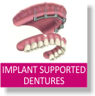 Implant Supported Dentures