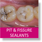 Pit & Fissure Sealants